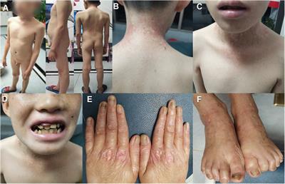 Identification of a novel FERMT1 variant causing kindler syndrome and a review of the clinical and molecular genetic features in Chinese patients